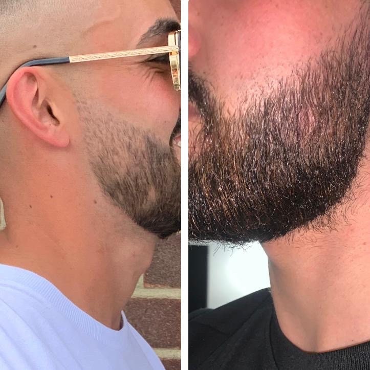 Derma roller | microneedle | beard roller | hair growth treatment | alopecia loss | Hair Growth