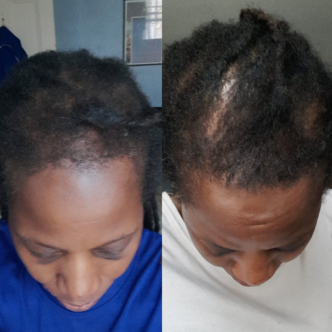Derma roller | microneedle | beard roller | hair growth treatment | alopecia loss | Hair Growth